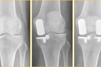 Behandlung einer Knie-Arthrose mit 2 Schlittenporothesen